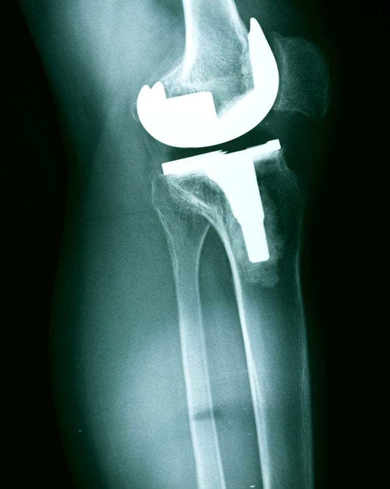 Knee Replacement Surgery