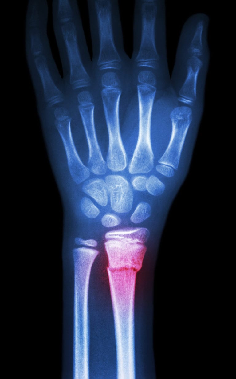 Wrist Fractures