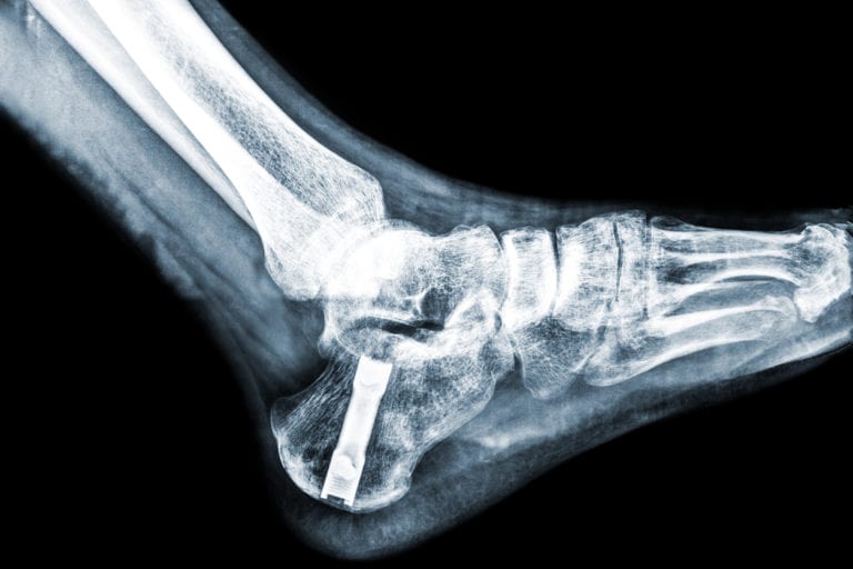 Ankle Replacement