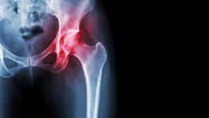 Xray of a patient with hip arthritis