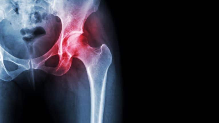 Xray of a patient with hip arthritis