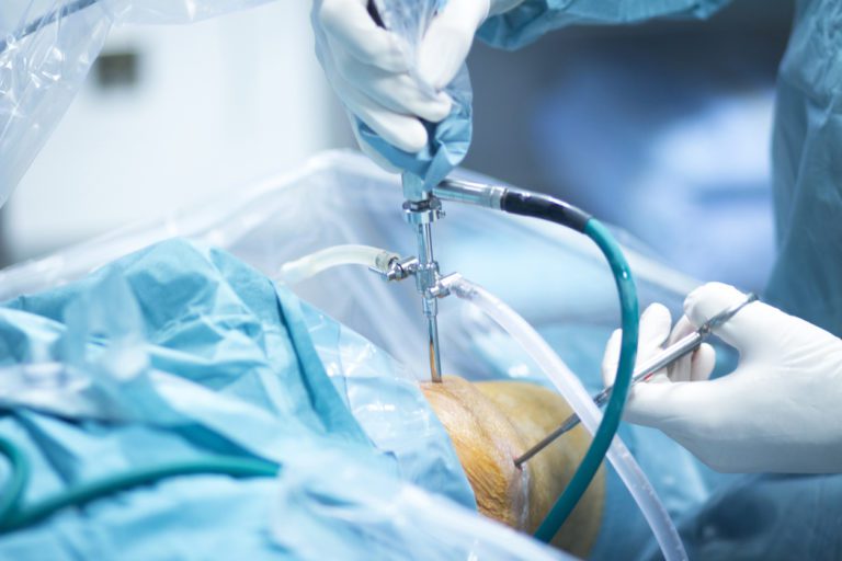Orthopaedic surgeons Operates Arthroscopic Knee Surgery on Patient