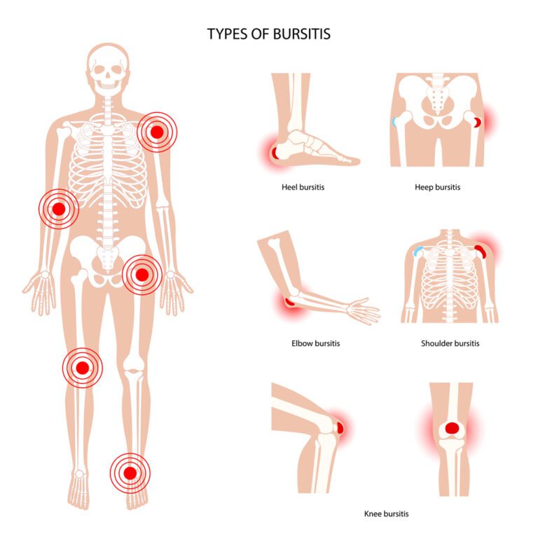 Type of Bursitis