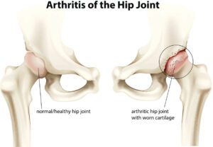 Arthritis of the hip joint
