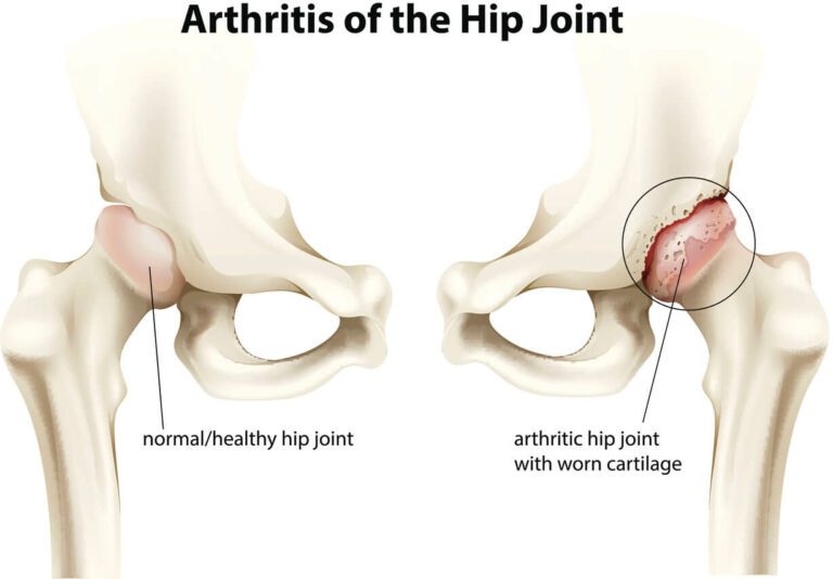 Arthritis of the hip joint