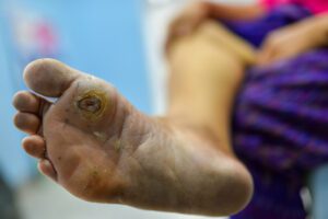 Diabetes foot at sole of foot and sole of big toe