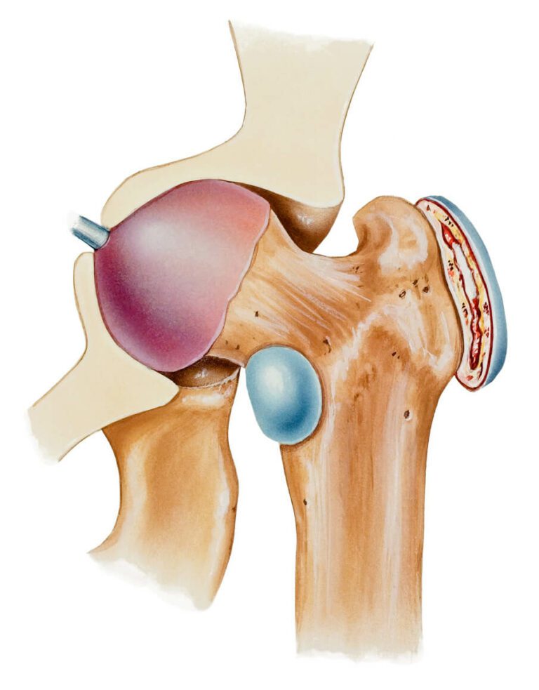 Hip Bursitis