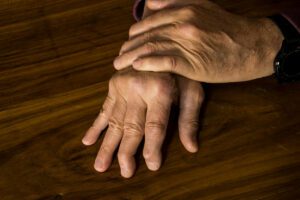 A male with psoriatic arthritis is experiencing symptoms in his hands.