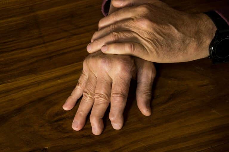 A male with psoriatic arthritis is experiencing symptoms in his hands.