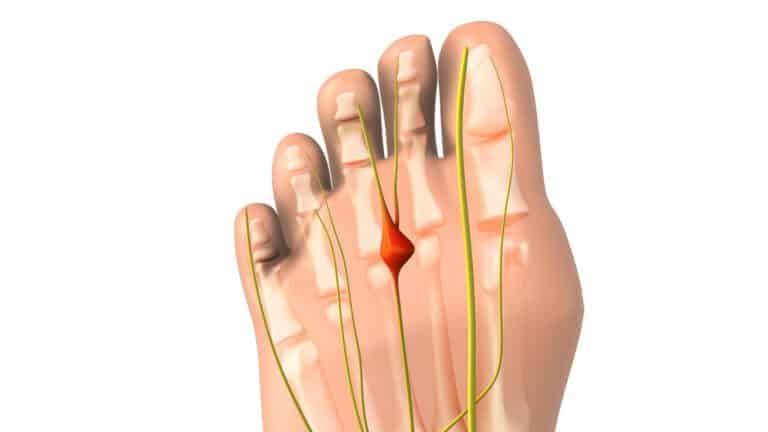 An animated image of a foot with a pinched nerve to depict Morton's neuroma medical condition.