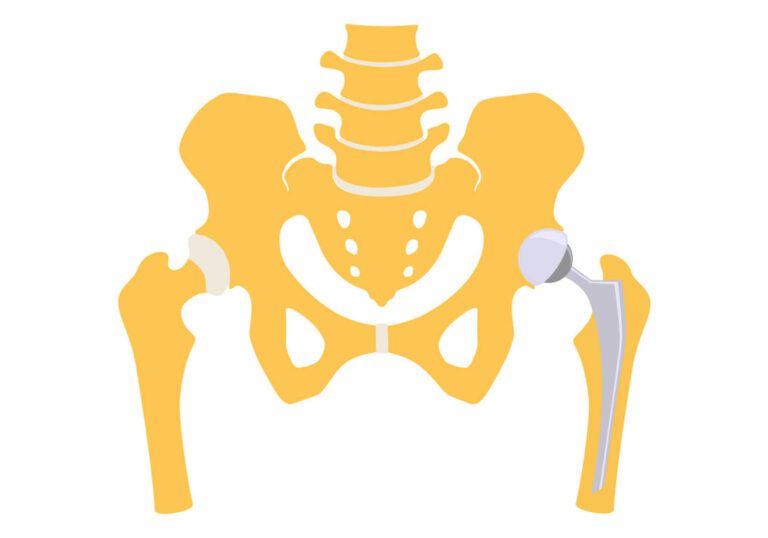hip replacement illustration