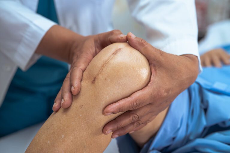 An elderly old lady woman patient show her scars surgical total knee joint replacement.