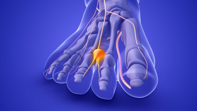 3D illustration of a Morton's neuroma on a foot nerve.