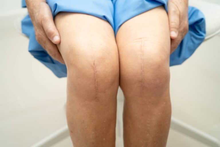 An elderly woman patient with scar knee replacement surgery in hospital.