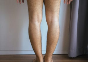 Blount's Disease