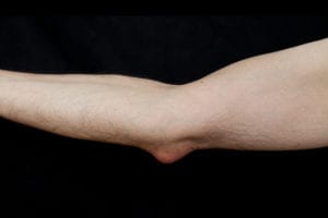 Elbow Bursitis