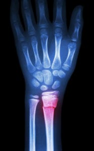 Wrist Fractures