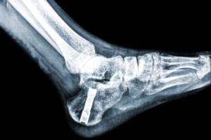 Ankle Replacement