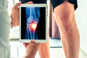 Doctor holding up a digital x-ray of a patient's knee
