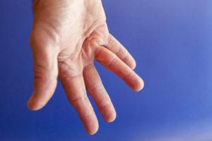 Hand of an man with Dupuytren contracture