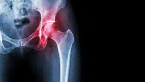Xray of a patient with hip arthritis