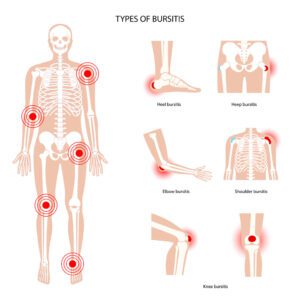 Type of Bursitis