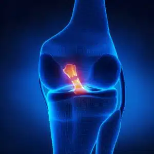 Torn Anterior Cruciate Ligament Visualization Image