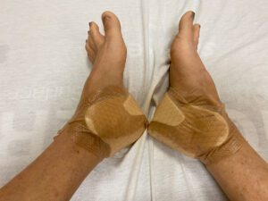 Patient's feet are bandaged after ankle replacement surgery