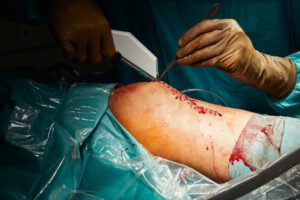 Knee ligament reconstruction surgery