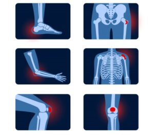 Common types of bursitis. Inflamed bursa in human body. Elbow, shoulder, knee pain. Ankle hip and foot inflammation. Treatment and injection concept. Anatomical poster flat medical vector illustration