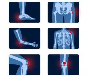 Common types of bursitis. Inflamed bursa in human body. Elbow, shoulder, knee pain. Ankle hip and foot inflammation. Treatment and injection concept. Anatomical poster flat medical vector illustration