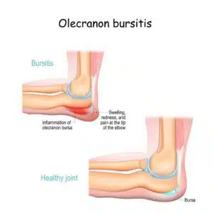 Olecranon bursitis.