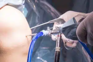 knee arthroscopy micro surgery in hospital operating theater emergency room