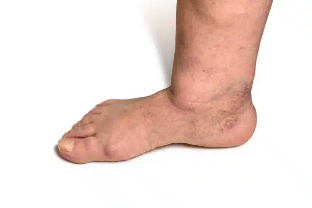 Treatment and Care for a Diabetic Foot The Bone Joint Center