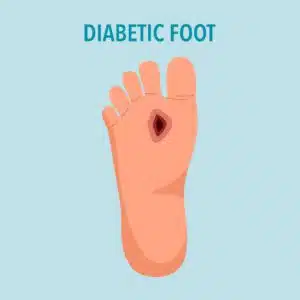 Diabetic foot syndrome concept