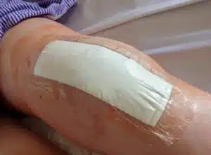 Senior woman's knee after partial knee replacement surgery