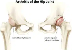Arthritis of the hip joint