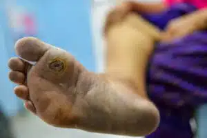 Diabetes foot at sole of foot and sole of big toe