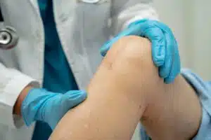 Doctor check Asian senior or elderly old lady woman patient scars surgical total knee joint replacement