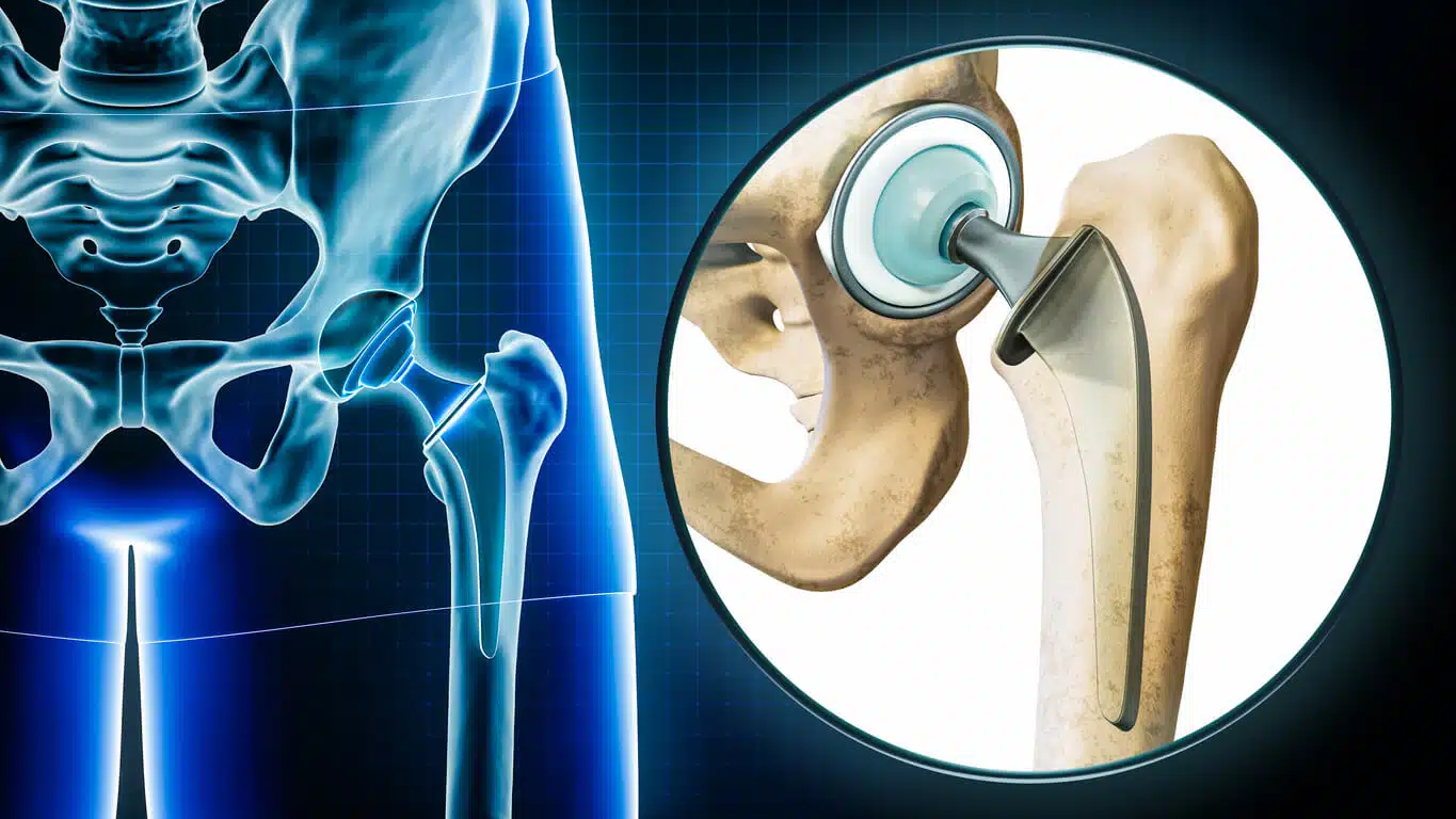 How to Avoid Complications After Hip Replacement Surgery