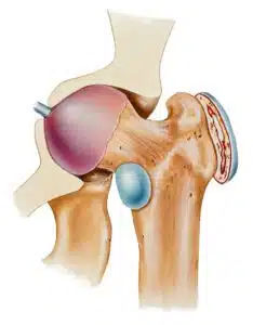 Hip Bursitis