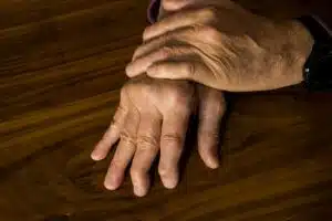 A male with psoriatic arthritis is experiencing symptoms in his hands.
