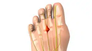 An animated image of a foot with a pinched nerve to depict Morton's neuroma medical condition.
