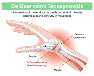 Inflammation of thumb tendons from De Quervain's Tenosyvitis