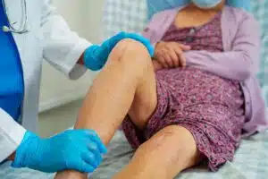 Asian elderly woman patient with scar knee replacement surgery