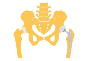 hip replacement illustration