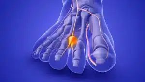 3D illustration of a Morton's neuroma on a foot nerve.